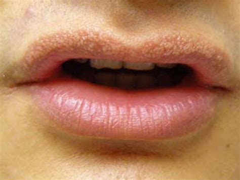 White Spots On Lips Causes Pictures Small On Lower Upper Inside
