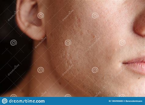 Acne Scars On The Face Stock Photo Image Of Medicine 180490688