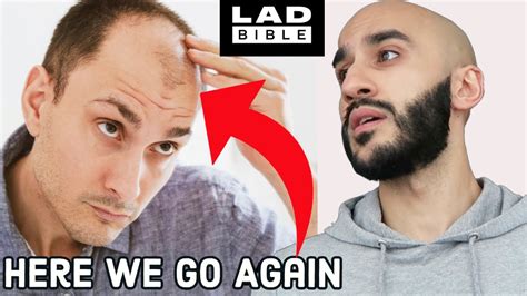 The Cure For Baldness According To Ladbible Why Hair Loss Is