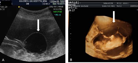 Figure 2 From Prenatal Diagnosis Of Large Subamniotic Cyst Compressing