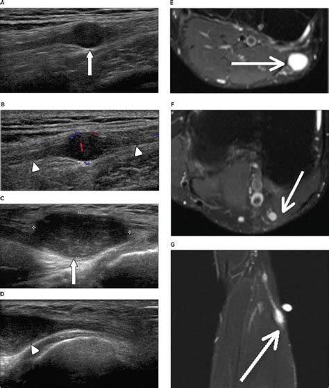 Sonographic Evaluation Of Common Peroneal Neuropathy In Patients With