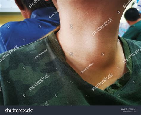 Anterior Neck Swelling Goitre Due Enlargement Stock Photo 1650441649