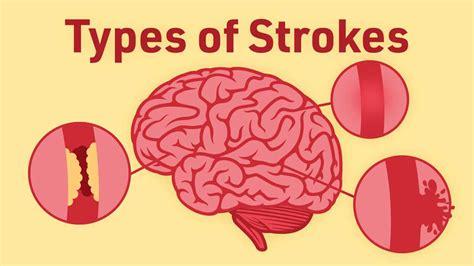 Different Types Of Stroke Ausmed