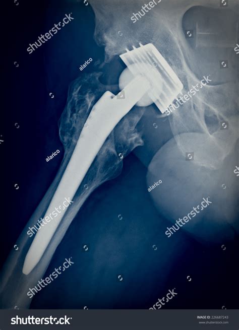 Xray Imaging Permanent Total Hip Arthroplasty Stock Photo 226687243