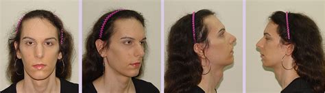 dr chettawut sex reassignment and facial feminization surgery center facial feminization