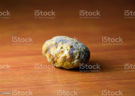 Large Gallstone Gall Bladder Stone The Result Of Gallstones Stock Photo