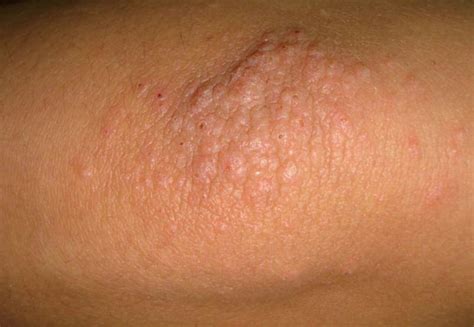 Itchy Elbows Causes Symptoms Rash Bumps Treatments And SexiezPix Web Porn