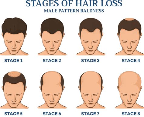 Hair Loss In Men Male Hair Loss Cranial Prosthesis Center