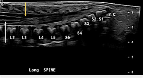 Spinal Ultrasound Longitudinal Spinal Ultrasound Demonstrates A
