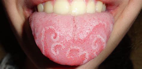 Geographic Tongue The Mysterious Condition That Makes Maps In Your Mouth