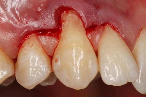 Treatment Of Gingival Recession When And How Imber International