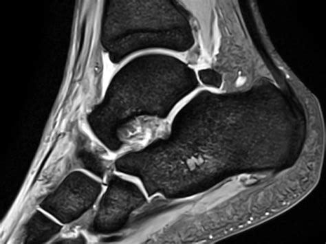 Lateral Ankle Sprain Mri Online