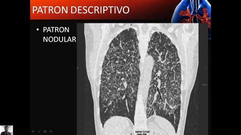 Neumopatías intersticiales idiopáticas Dr Patricio Chacón YouTube