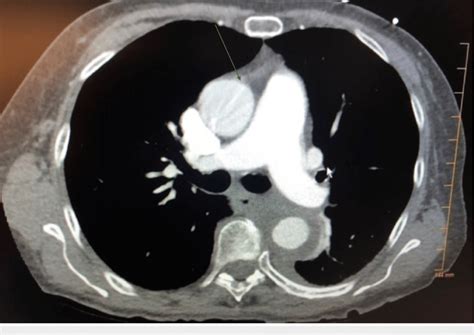 Aortic Dissection With Extravasation Ct Scan Of The Chest With Download Scientific Diagram