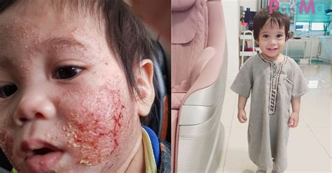 Terdapat kajian yang menunjukkan bahawa madu adalah lebih baik jika dibandingkan dengan ubat batuk dextromethorphan walaupun jarak kebaikkannya adalah sedikit. Ubat Gatal Untuk Bayi - Opening q