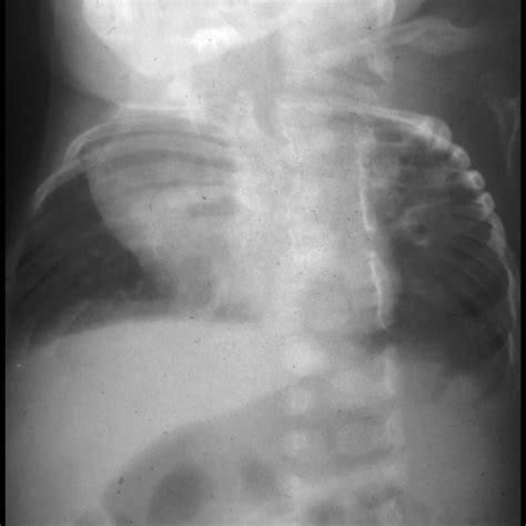 Pulmonary Hypoplasia Pediatric Radiology Reference Article Pediatric Imaging Pedsimaging