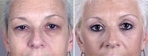 Lower Eyelid Lift In New Jersey Parker Center For Plastic Surgery