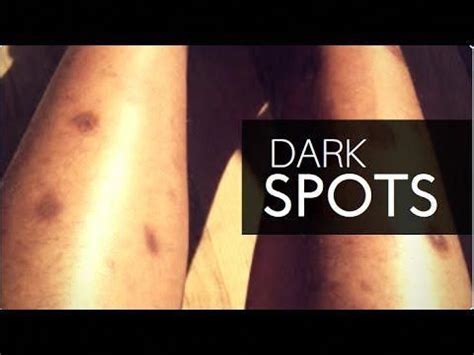 What is the best cure for dark spots? HOW TO GET RID OF DARK SPOTS ON LEGS & BODY FAST | GET ...
