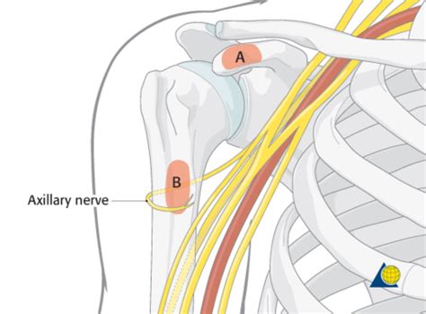 Brachial Plexus Injuries Flashcards Quizlet