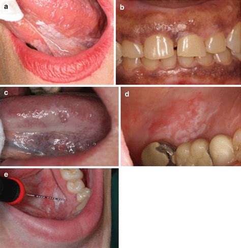 Common Lesions In Oral Pathology For The General Dentist Pocket Dentistry