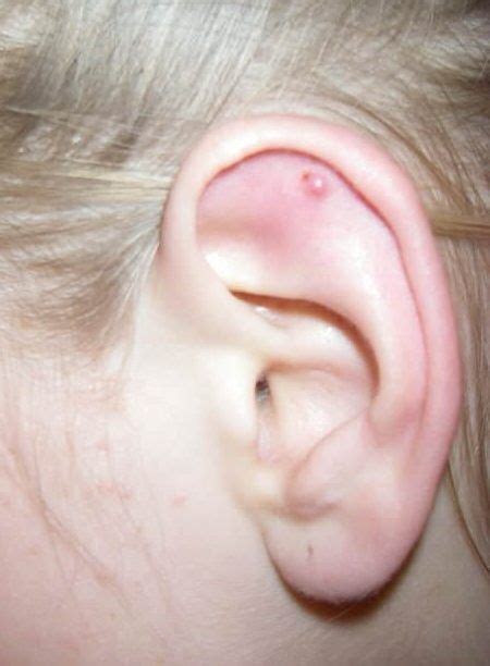 Maybe you would like to learn more about one of these? Keloids On Piercings - How Do You Get Rid Of Them | Keloid ...