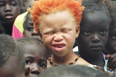 Others have red hair or blonde hair or other colours. Beautiful albino African American child, with the most ...
