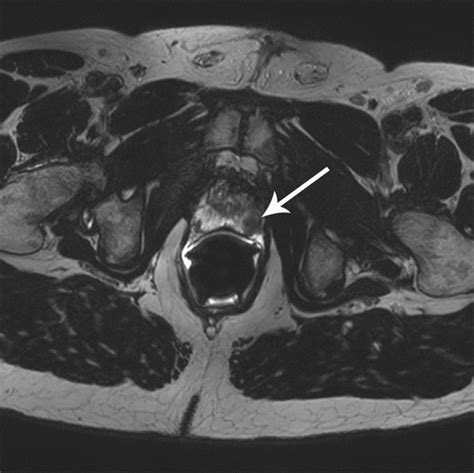 Multiparametric Mr Imaging Of The Prostate After Treatment Of Prostate