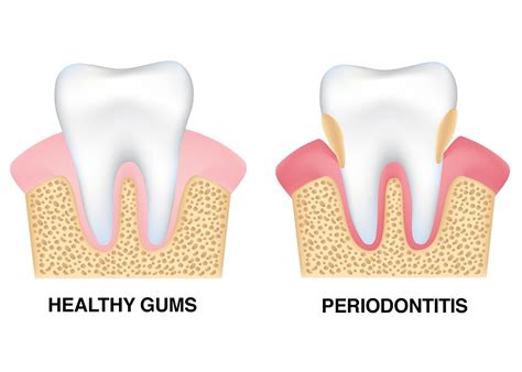 Toronto ON Gum Disease And Tooth Loss Periodontal Health Affects Your Smile