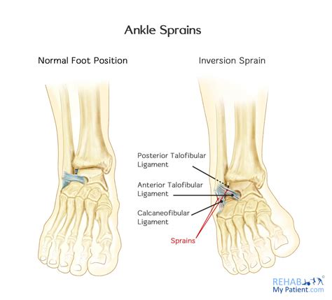 Ankle Sprains Medial And Lateral Rehab My Patient
