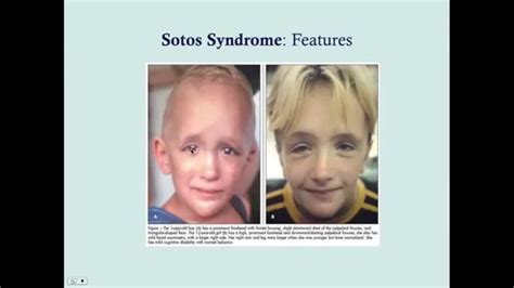 Sotos Syndrome Crash Usmle Step 2 And 3 Syndrome Soto Youtube
