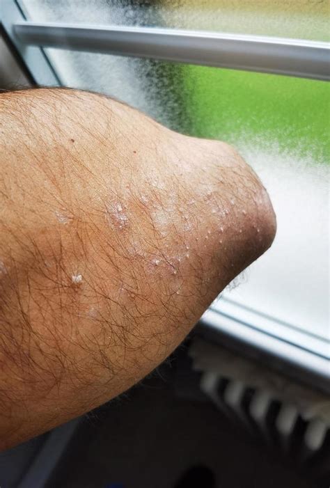 The Chronic Disease Of Psoriasis In The Elbow Of An Arm Of An Adult Man