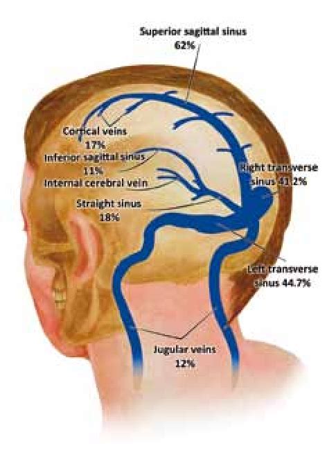 Figure From Cerebral Venous Sinus Thrombosis Semantic Scholar