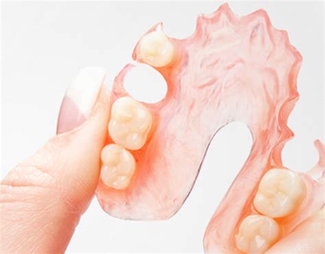 Flex Partial Denture