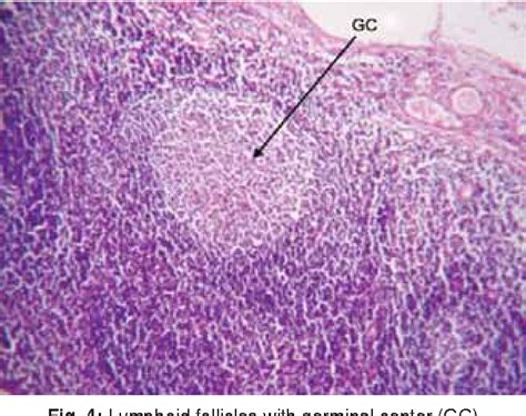 Tonsil Cysts Popped