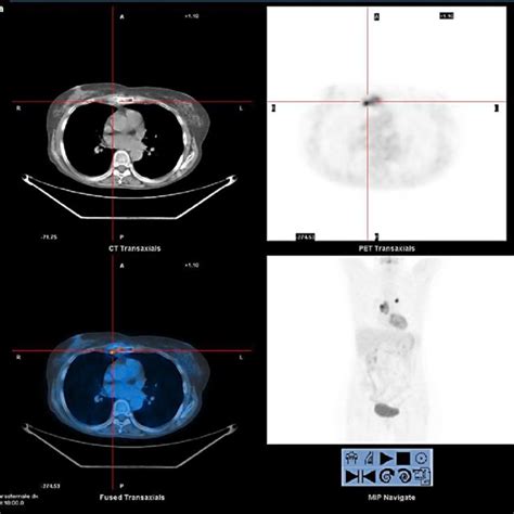 Case 1 Fdg Petct Scan Shows Increased Uptakes In Bilateral Internal