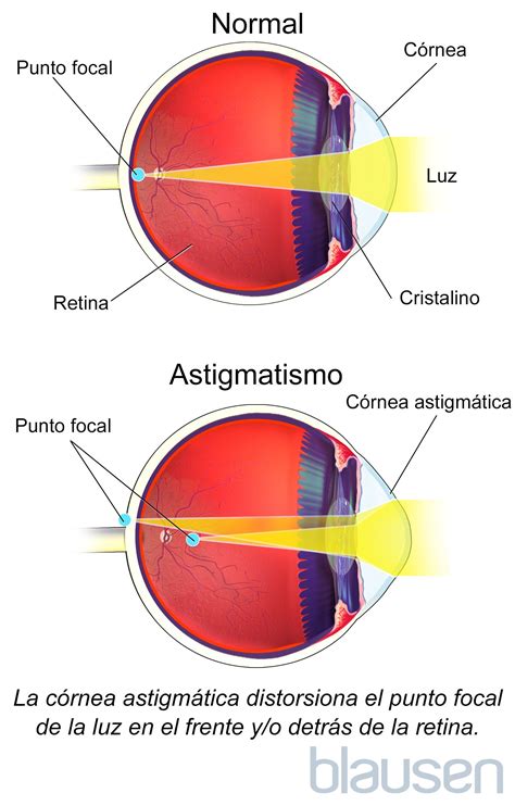 Glaucoma Pathophysiology Flow Chart Astigmatism Glaucoma Swollen Eyes