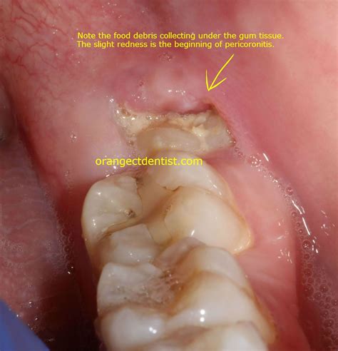 Photo Of Early Stage Pericoronitis Of A Lower Left Wisdom Tooth On A