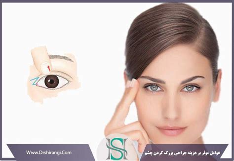 اپی کانتال جراحی بزرگ کردن چشم بهترین جراح اپی کانتوپلاستی در تهران دکتر سعید شیرنگی