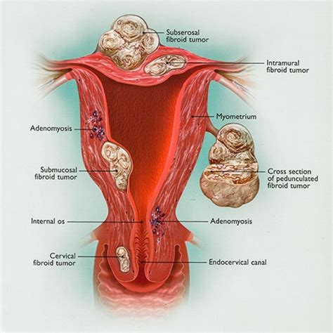 Fibroids Treatment What Are Your Options