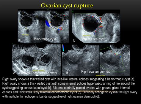 Ruptured Ovarian Cyst