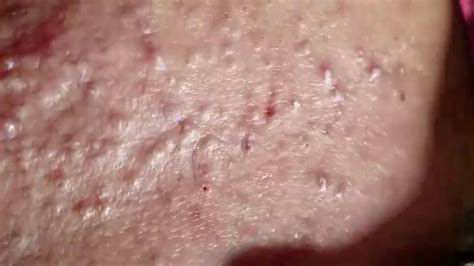 🔥 Pimple Popping 2020 Video Blackheads Extraction Blackheads Removal
