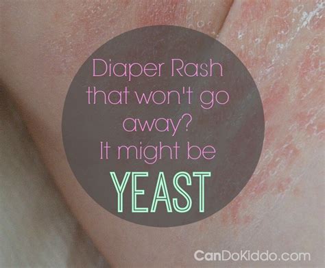 Tips For Fighting A Yeast Diaper Rash Cando Kiddo