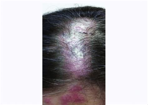 Chronic Skin Lesions Of Discoid Lupus Eritematosus Showing