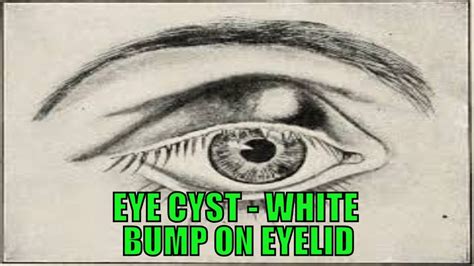 Eye Cyst White Bump On Eyelid Youtube