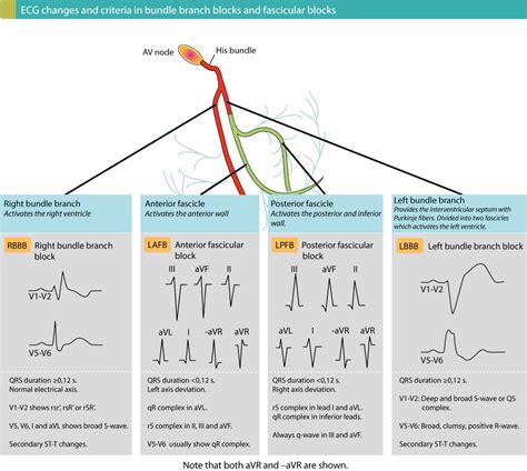 Intraventricular Conduction Delay Bundle Branch Blocks And Fascicular