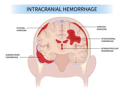 Intracranial Hemorrhage Advocate Health Care