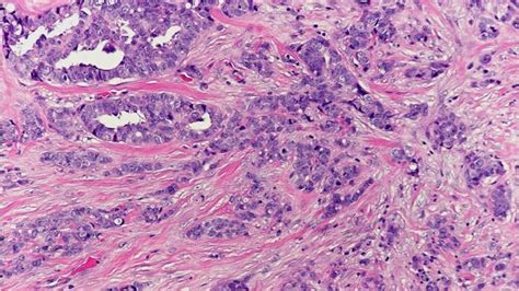 Invasive Ductal Carcinoma Histology
