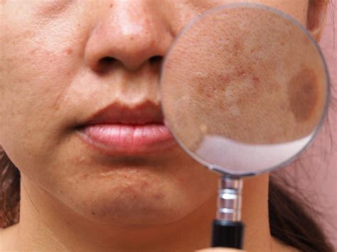 6 Ways To Get Rid Of Brown Spots On Face Melasma Charlies