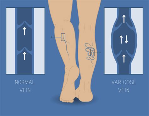 Types Of Vein Treatments Archives The Vein Center Of Maryland