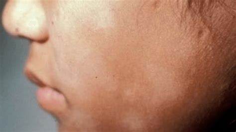 What Causes White Spots On Face